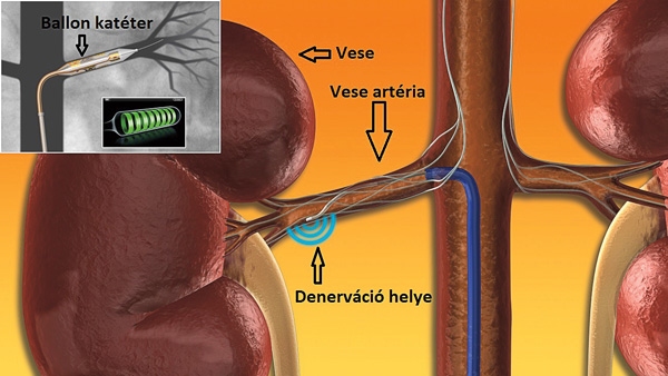 Az idegszálak szorosan körülölelik a veseartériát, így az éren keresztül „elérhetők”
